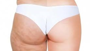 Sai che cosa è la cellulite?