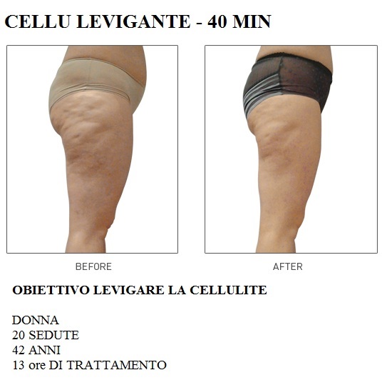 Lpg Risultati Prima E Dopo I risultati di LPG e alcune domande e risposte